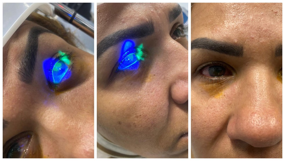 Queimadura nos olhos após uso de sérum para cílios: internautas relatam reações e médicos fazem alerta Queimadura nos olhos após uso de sérum para cílios: internautas relatam reações e médicos fazem alerta