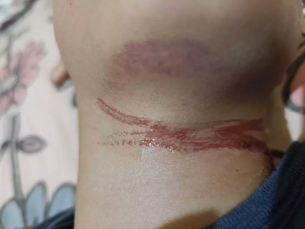 Fio solto fere pescoço de criança em Rio Brilhante Fio solto fere pescoço de criança em Rio Brilhante