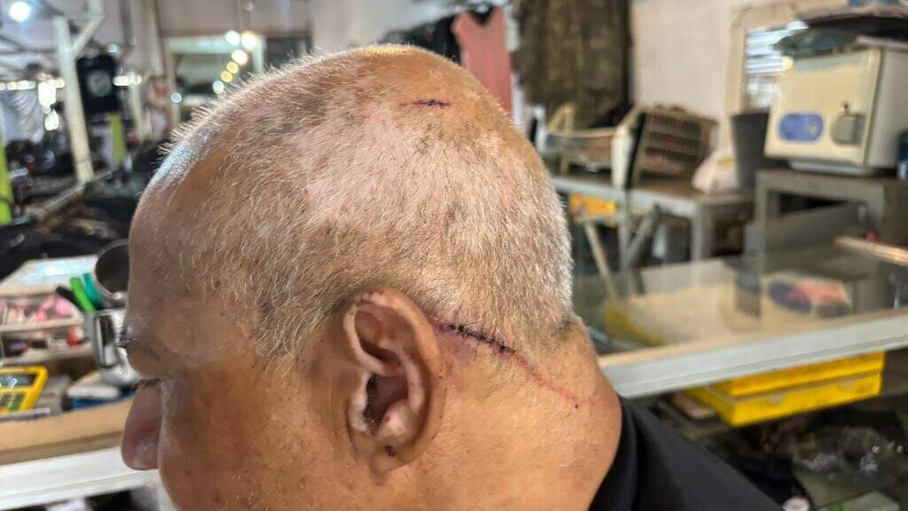 “Me livrei da morte 2 vezes”, diz comerciante ferido em tentativa de roubo