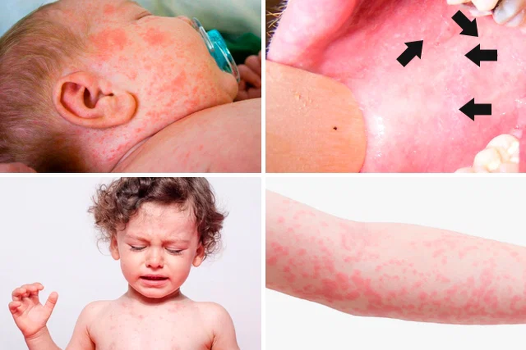 Sarampo: 10 sinais que pedem atenção em crianças e gestantes Sarampo: 10 sinais que pedem atenção em crianças e gestantes